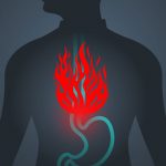 reflux treated naturally